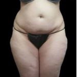 Female Liposuction Before & After Patient #967