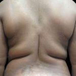 Female Liposuction Before & After Patient #970