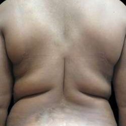 Female Liposuction Before & After Patient #970