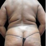 Female Liposuction Before & After Patient #981