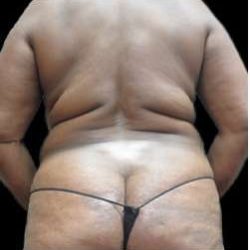 Female Liposuction Before & After Patient #981