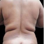 Female Liposuction Before & After Patient #986