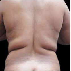 Female Liposuction Before & After Patient #986