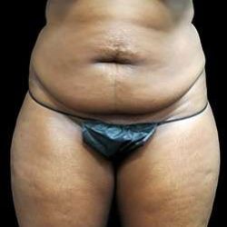 Female Liposuction Before & After Patient #995