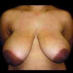 Liposuction and Breast Reduction Before & After Patient #661