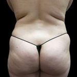 Female Liposuction Before & After Patient #1005