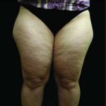 Female Liposuction Before & After Patient #1019