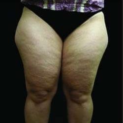 Female Liposuction Before & After Patient #1019