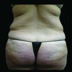 Female Liposuction Before & After Patient #1022