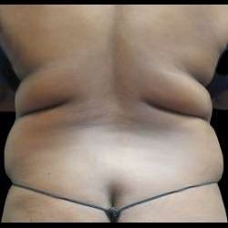 Female Liposuction Before & After Patient #1025