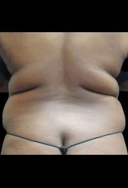 Female Liposuction Before & After Patient #1025