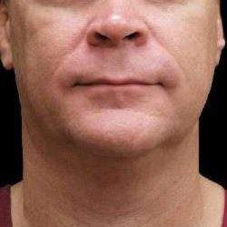 Male Liposuction Before & After Patient #1032
