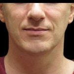 Male Liposuction Before & After Patient #1039