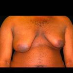 Male Liposuction Before & After Patient #1064
