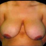 Liposuction and Breast Reduction Before & After Patient #672