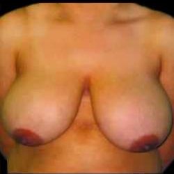 Liposuction and Breast Reduction Before & After Patient #672