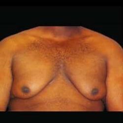 Male Liposuction Before & After Patient #1071