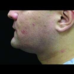 Male Liposuction Before & After Patient #1092