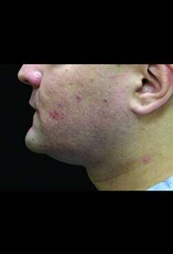 Male Liposuction Before & After Patient #1092