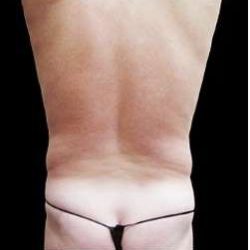 Male Liposuction Before & After Patient #1099