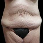 Liposuction and Mommy Makeover Before & After Patient #1112