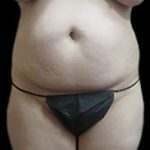 Liposuction and Mommy Makeover Before & After Patient #1133