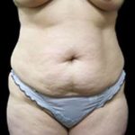 Liposuction and Mommy Makeover Before & After Patient #1150
