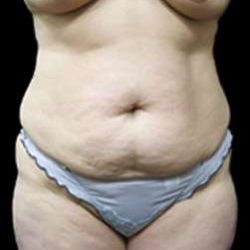 Liposuction and Mommy Makeover Before & After Patient #1150
