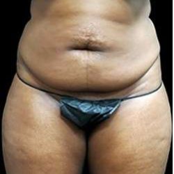 Liposuction and Mommy Makeover Before & After Patient #1157