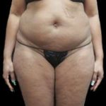 Liposuction and Mommy Makeover Before & After Patient #1177