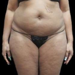 Liposuction and Mommy Makeover Before & After Patient #1177