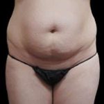 Liposuction and Mommy Makeover Before & After Patient #1186