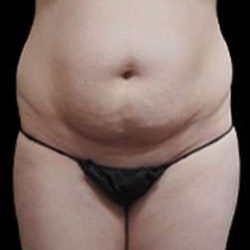 Liposuction and Mommy Makeover Before & After Patient #1186