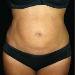 Liposuction and Mommy Makeover Before & After Patient #1193