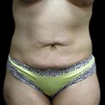 Liposuction and Mommy Makeover Before & After Patient #1218