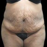 Liposuction and Mommy Makeover Before & After Patient #1231