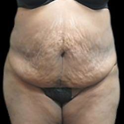 Liposuction and Mommy Makeover Before & After Patient #1231