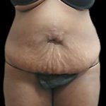 Liposuction and Mommy Makeover Before & After Patient #1240