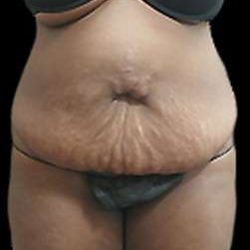 Liposuction and Mommy Makeover Before & After Patient #1240