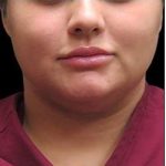 Laser Neck Lift and Submental Liposuction Before & After Patient #1258