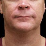 Laser Neck Lift and Submental Liposuction Before & After Patient #1272