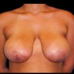 Liposuction and Breast Reduction Before & After Patient #694