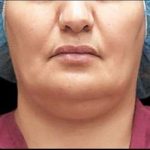 Laser Neck Lift and Submental Liposuction Before & After Patient #1279