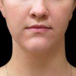 Laser Neck Lift and Submental Liposuction Before & After Patient #1286