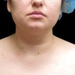 Laser Neck Lift and Submental Liposuction Before & After Patient #1297