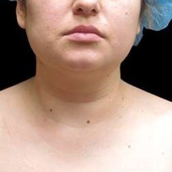 Laser Neck Lift and Submental Liposuction Before & After Patient #1297