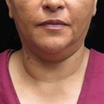 Laser Neck Lift and Submental Liposuction Before & After Patient #1315