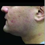 Laser Neck Lift and Submental Liposuction Before & After Patient #1318