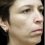 Laser Neck Lift and Submental Liposuction Before & After Patient #1321