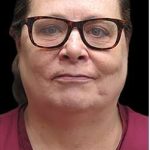 Laser Neck Lift and Submental Liposuction Before & After Patient #1328